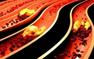 Clogged arteries are part of the many heart attack causes