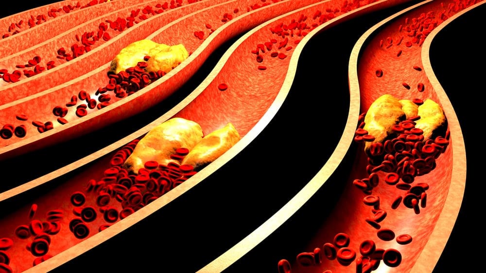 Clogged arteries are part of the many heart attack causes